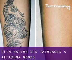 Élimination des tatouages à Altadena Woods