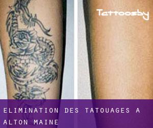 Élimination des tatouages à Alton (Maine)