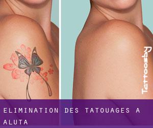 Élimination des tatouages à Aluta