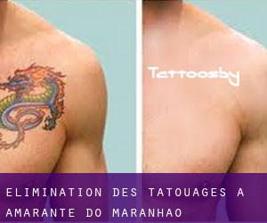 Élimination des tatouages à Amarante do Maranhão