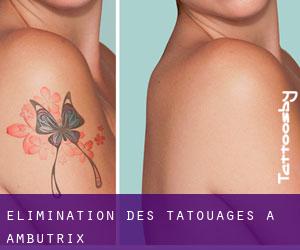 Élimination des tatouages à Ambutrix