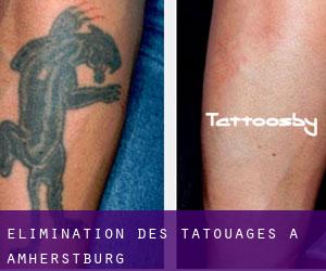 Élimination des tatouages à Amherstburg