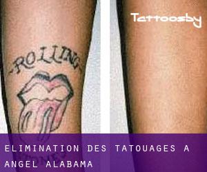 Élimination des tatouages à Angel (Alabama)