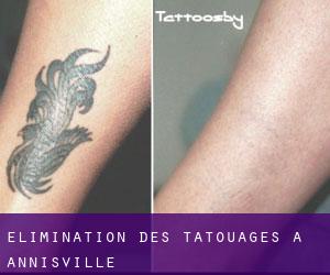 Élimination des tatouages à Annisville