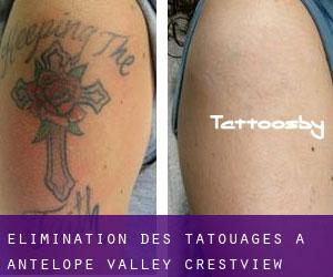 Élimination des tatouages à Antelope Valley-Crestview