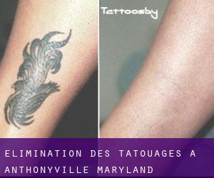 Élimination des tatouages à Anthonyville (Maryland)