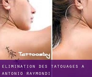 Élimination des tatouages à Antonio Raymondi