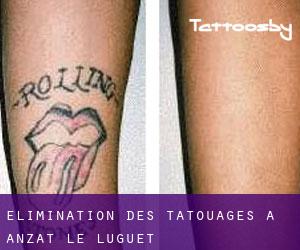 Élimination des tatouages à Anzat-le-Luguet