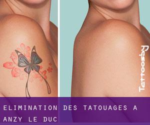 Élimination des tatouages à Anzy-le-Duc