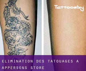 Élimination des tatouages à Appersons Store