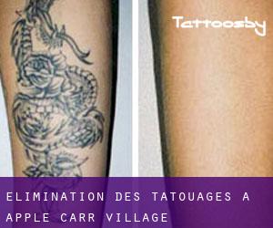 Élimination des tatouages à Apple Carr Village