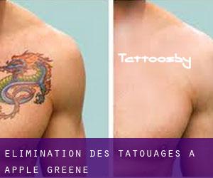 Élimination des tatouages à Apple Greene