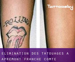 Élimination des tatouages à Apremont (Franche-Comté)