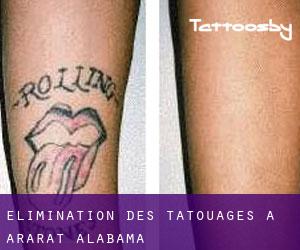 Élimination des tatouages à Ararat (Alabama)