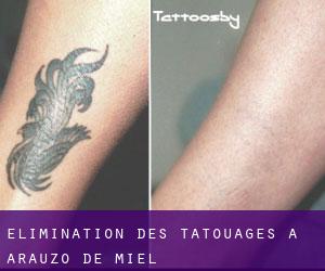 Élimination des tatouages à Arauzo de Miel