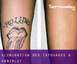 Élimination des tatouages à Arbirlot
