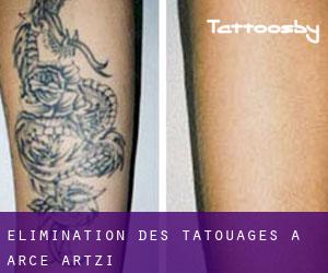 Élimination des tatouages à Arce / Artzi