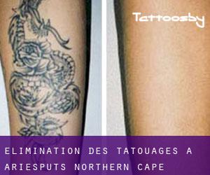Élimination des tatouages à Ariesputs (Northern Cape)
