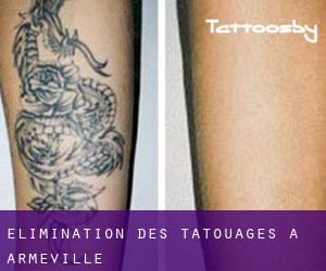 Élimination des tatouages à Armeville