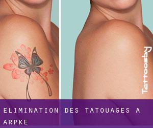 Élimination des tatouages à Arpke