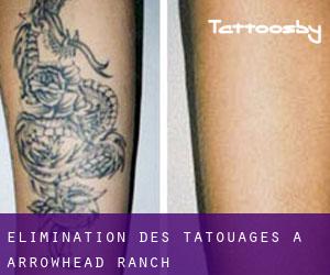 Élimination des tatouages à Arrowhead Ranch