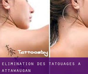 Élimination des tatouages à Attawaugan