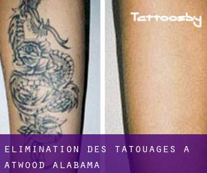 Élimination des tatouages à Atwood (Alabama)
