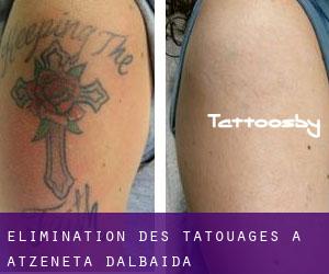 Élimination des tatouages à Atzeneta d'Albaida