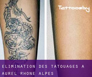Élimination des tatouages à Aurel (Rhône-Alpes)