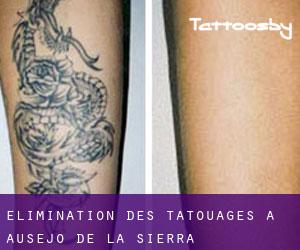 Élimination des tatouages à Ausejo de la Sierra