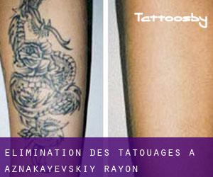 Élimination des tatouages à Aznakayevskiy Rayon