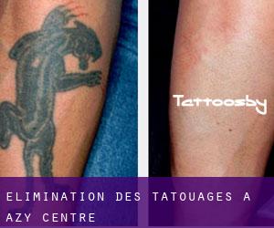 Élimination des tatouages à Azy (Centre)