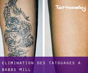 Élimination des tatouages à Babbs Mill