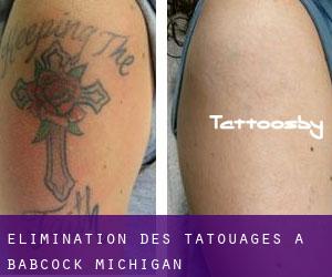 Élimination des tatouages à Babcock (Michigan)