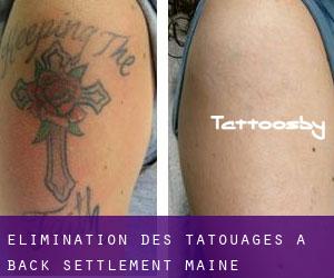 Élimination des tatouages à Back Settlement (Maine)