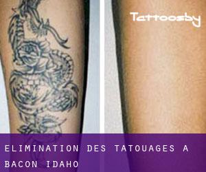 Élimination des tatouages à Bacon (Idaho)