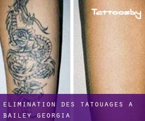 Élimination des tatouages à Bailey (Georgia)