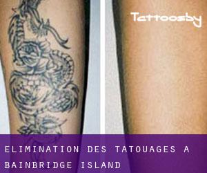 Élimination des tatouages à Bainbridge Island