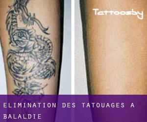 Élimination des tatouages à Balaldie