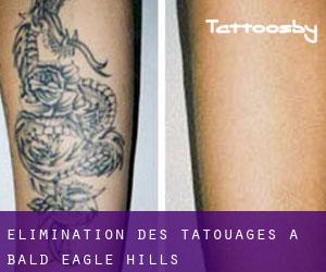 Élimination des tatouages à Bald Eagle Hills
