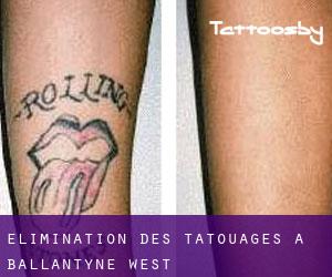 Élimination des tatouages à Ballantyne West