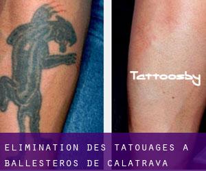 Élimination des tatouages à Ballesteros de Calatrava