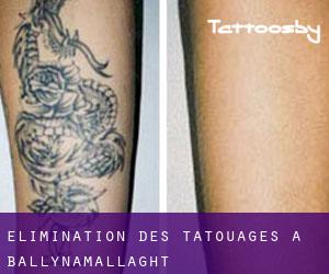 Élimination des tatouages à Ballynamallaght