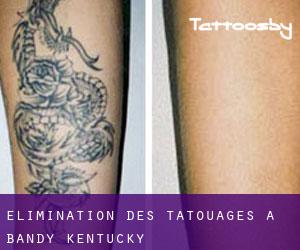 Élimination des tatouages à Bandy (Kentucky)