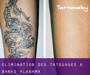 Élimination des tatouages à Banks (Alabama)