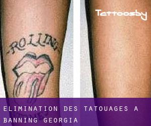 Élimination des tatouages à Banning (Georgia)