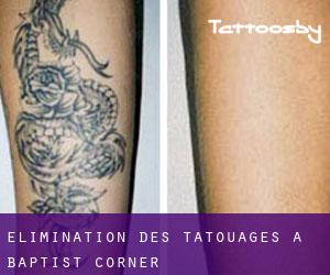 Élimination des tatouages à Baptist Corner