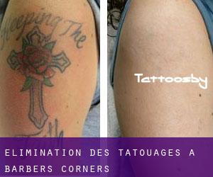 Élimination des tatouages à Barbers Corners