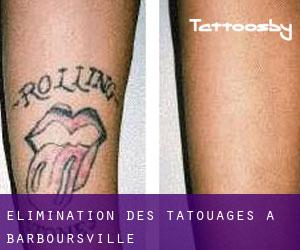 Élimination des tatouages à Barboursville