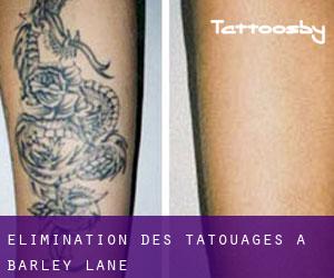 Élimination des tatouages à Barley Lane